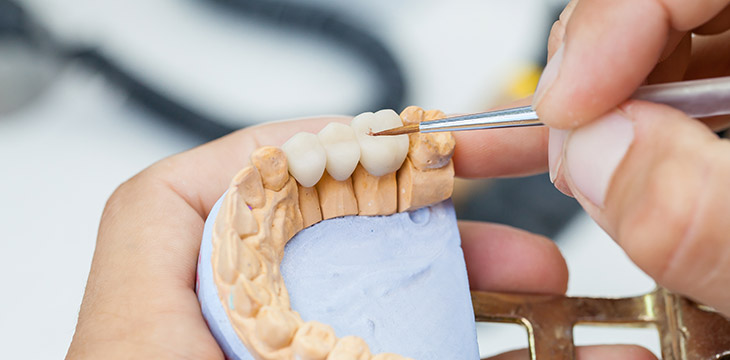 Kronen und Brücken beim Zahnarzt in Schwieberdingen